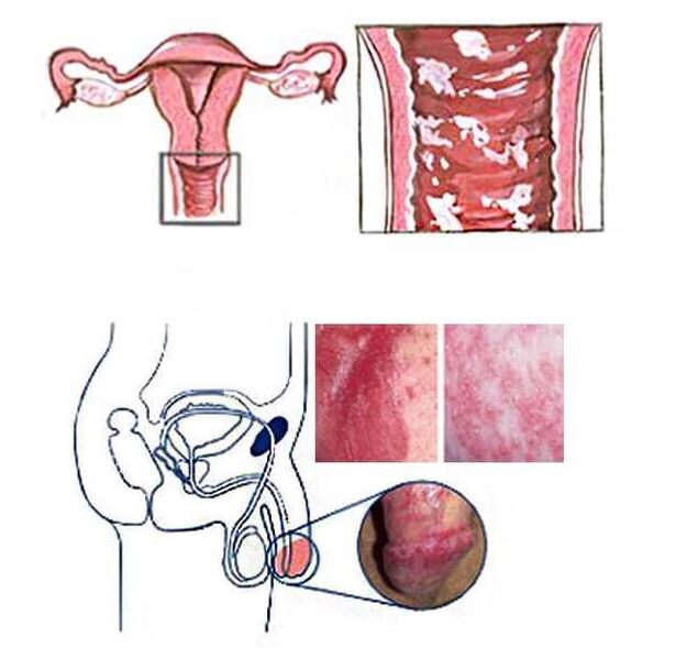 Candidiasis of male and female genital organs as a cause of pathological discharge